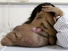 "Человеку-слону" окончательно удалили гигантскую опухоль