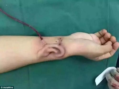 Китайские медики вырастили новое ухо на руке пациента