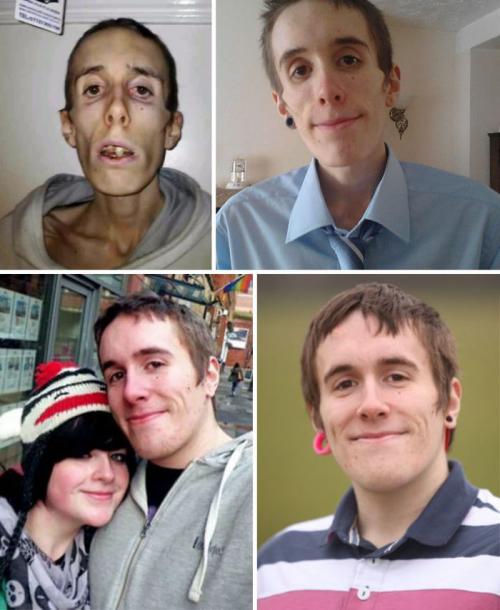 До и после: 20 примеров людей, сумевших побороть анорексию