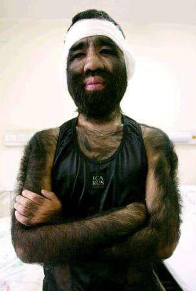 Ошибки природы: люди с редкими заболеваниями