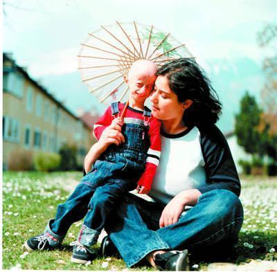 Ошибки природы: люди с редкими заболеваниями