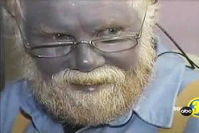 Ошибки природы: люди с редкими заболеваниями