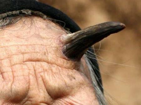 Ошибки природы: люди с редкими заболеваниями