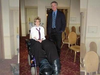 Ошибки природы: люди с редкими заболеваниями