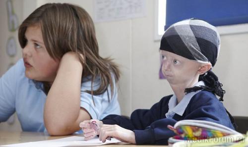 Ошибки природы: люди с редкими заболеваниями