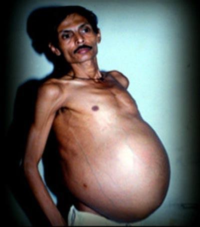 Ошибки природы: люди с редкими заболеваниями