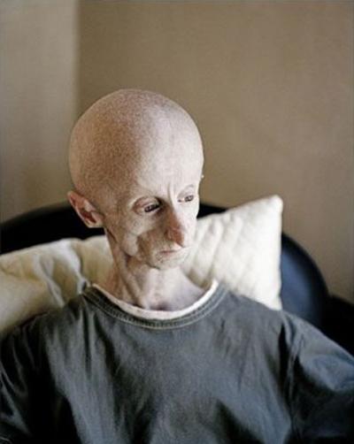 Ошибки природы: люди с редкими заболеваниями