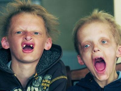 Ошибки природы: люди с редкими заболеваниями