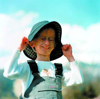 Ошибки природы: люди с редкими заболеваниями