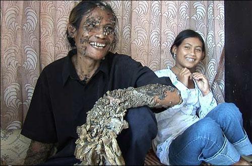 Ошибки природы: люди с редкими заболеваниями