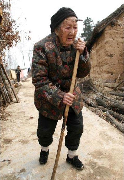 Ошибки природы: люди с редкими заболеваниями