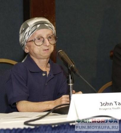 Ошибки природы: люди с редкими заболеваниями