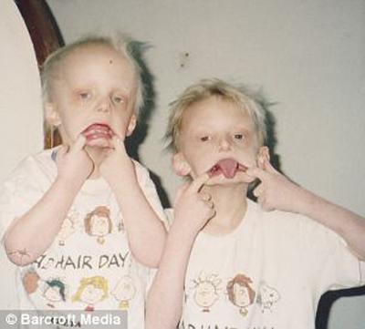 Ошибки природы: люди с редкими заболеваниями