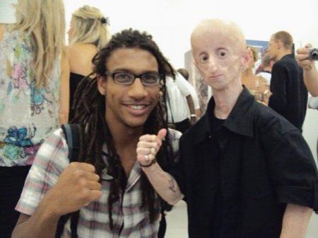 Ошибки природы: люди с редкими заболеваниями