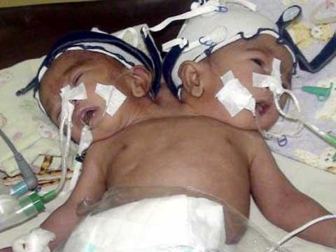 Ошибки природы: люди с редкими заболеваниями