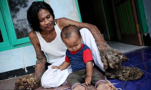 Врачи оказались бессильны помочь "человеку-дерево"