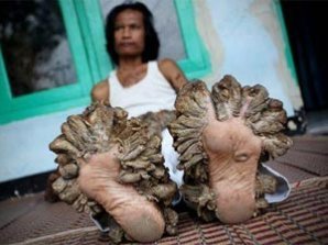 Врачи оказались бессильны помочь "человеку-дерево"