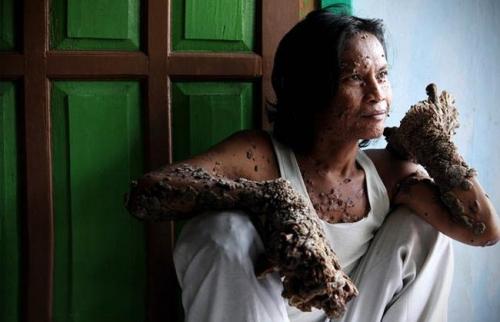 Врачи оказались бессильны помочь "человеку-дерево"