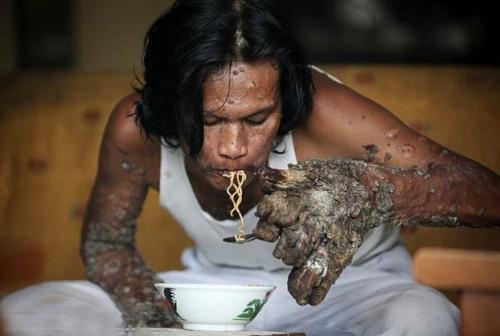 Врачи оказались бессильны помочь "человеку-дерево"