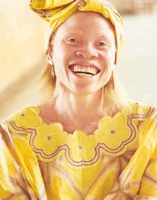 Альбинизм — дар или проклятие?