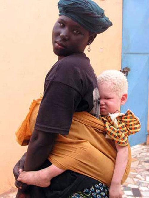 Альбинизм — дар или проклятие?