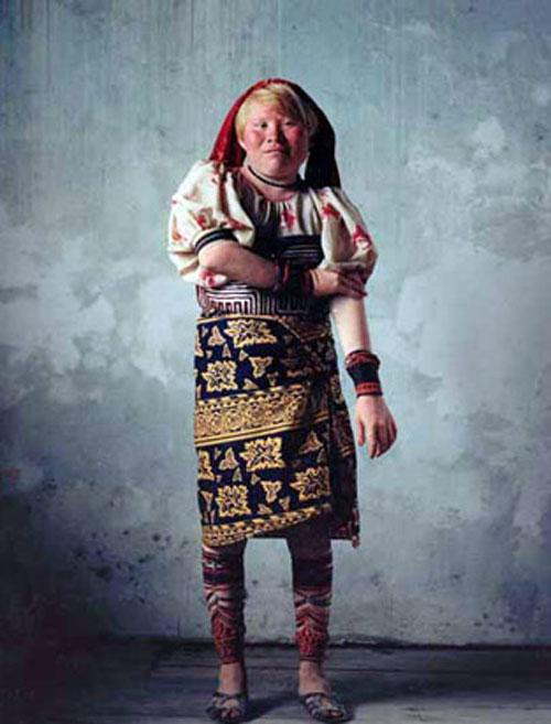 Альбинизм — дар или проклятие?