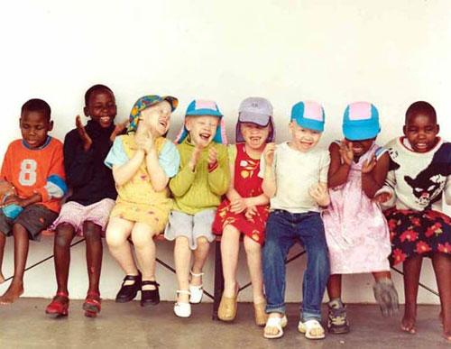 Альбинизм — дар или проклятие?