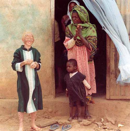 Альбинизм — дар или проклятие?