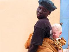 Альбинизм — дар или проклятие?