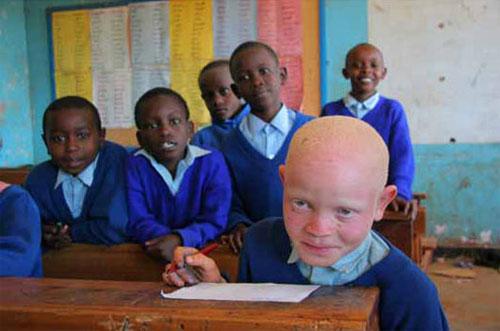 Альбинизм — дар или проклятие?