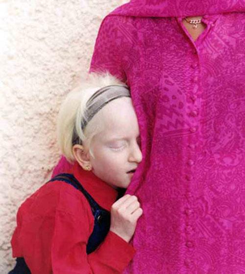 Альбинизм — дар или проклятие?