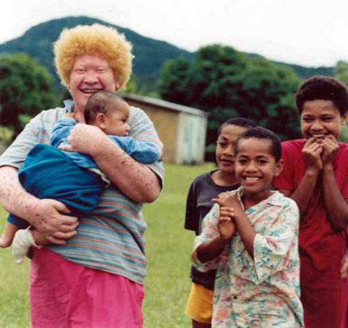 Альбинизм — дар или проклятие?