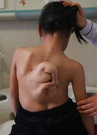В Китае прооперировали девочку с рукой на спине