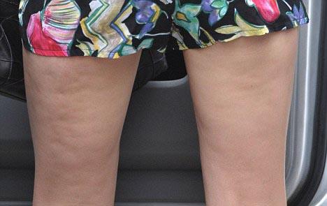 Модельную фигуру Миши Бартон испортил целлюлит