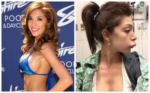 10 знаменитостей, которые сильно пожалели о сделанных пластических операциях