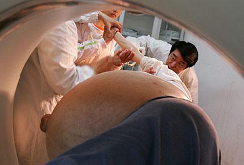 Китаянка вырастила 50-килограммовую опухоль