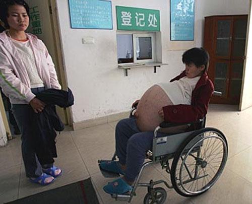 Китаянка вырастила 50-килограммовую опухоль