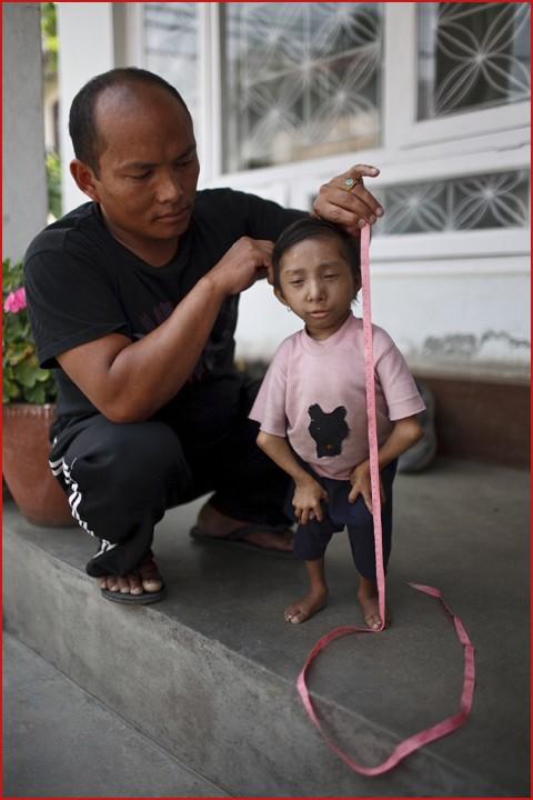 Самому маленькому в мире человеку исполнилось 18 лет