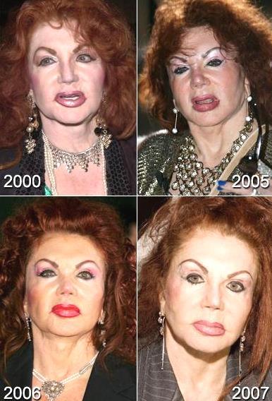 Топ-10 звезд, ставших жертвами пластической хирургии