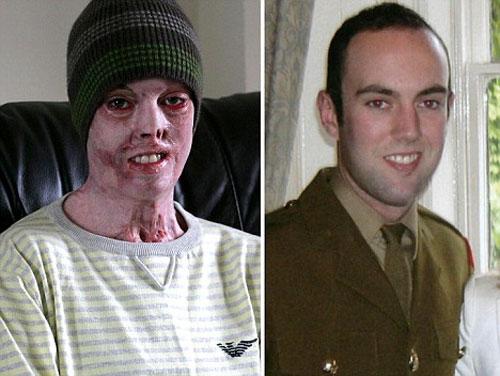 Сгоревший капрал сыграл свадьбу