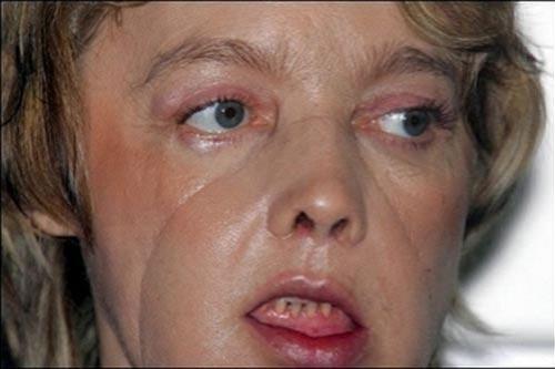 Год спустя: чем закончилась первая в мире операция по пересадке лица