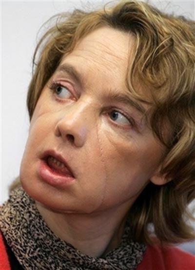 Год спустя: чем закончилась первая в мире операция по пересадке лица