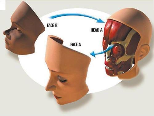Год спустя: чем закончилась первая в мире операция по пересадке лица