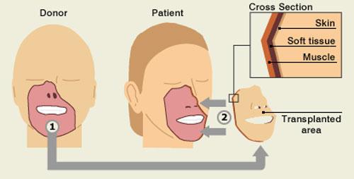 Год спустя: чем закончилась первая в мире операция по пересадке лица