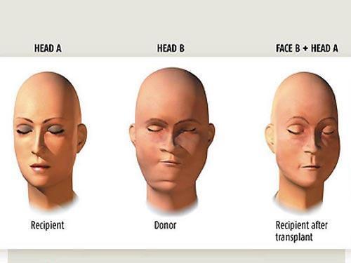Год спустя: чем закончилась первая в мире операция по пересадке лица