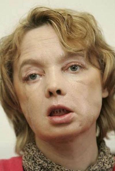 Год спустя: чем закончилась первая в мире операция по пересадке лица