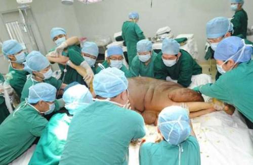 Хирурги 16 часов срезали с мужчины 108-килограммовую родинку