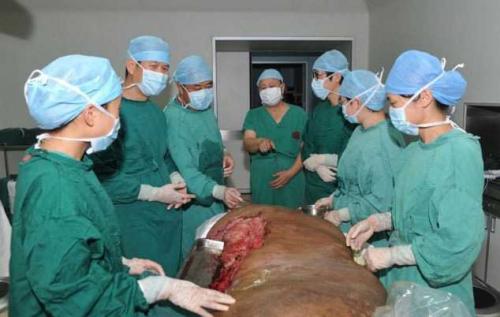 Хирурги 16 часов срезали с мужчины 108-килограммовую родинку