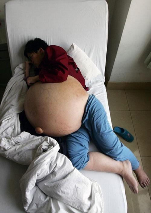 Китаянке отрезали 50-килограммовую опухоль