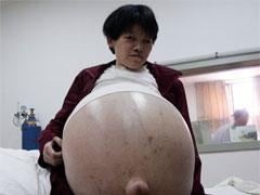 Китаянке отрезали 50-килограммовую опухоль